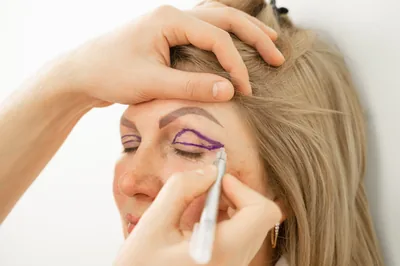 Blefaroplastie — operație de pleoape
