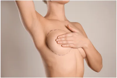 Implant mamar — augmentare sân